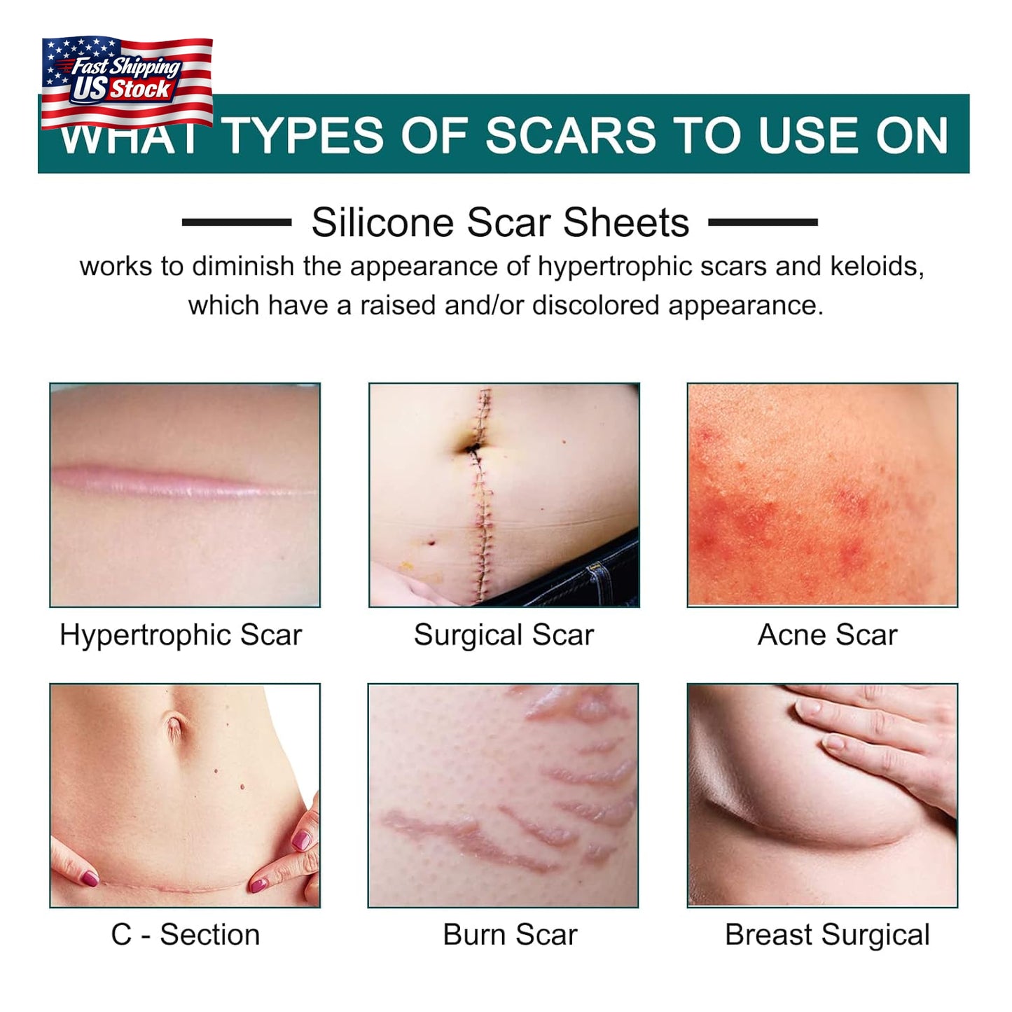 Silicone Scar Sheets (1.6” X 120” Roll-3M), Silicone Scar Tape Roll, Scar Silico