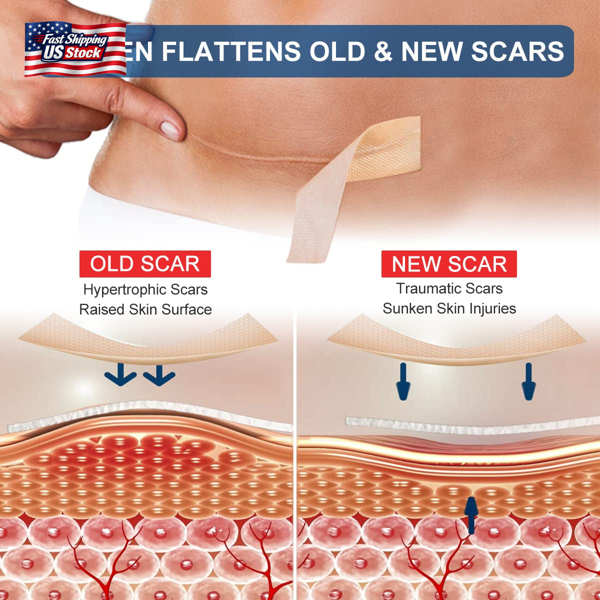 Silicone Scar Sheets (1.6” X 120” Roll-3M), Silicone Scar Tape Roll, Scar Silico