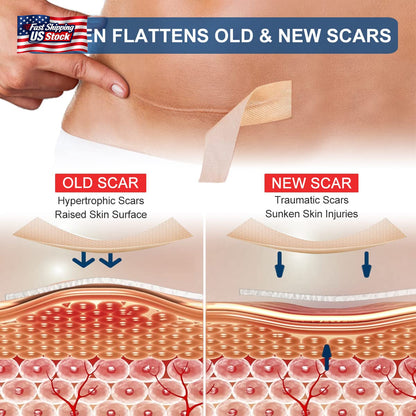 Silicone Scar Sheets (1.6” X 120” Roll-3M), Silicone Scar Tape Roll, Scar Silico