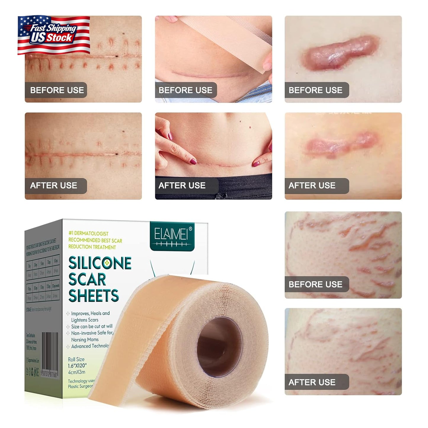 Silicone Scar Sheets (1.6” X 120” Roll-3M), Silicone Scar Tape Roll, Scar Silico