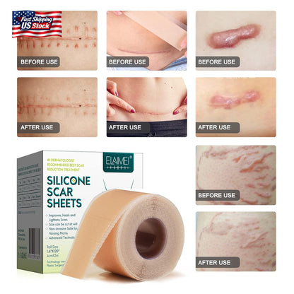 Silicone Scar Sheets (1.6” X 120” Roll-3M), Silicone Scar Tape Roll, Scar Silico